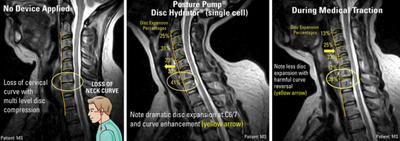 Loss of Neck Curve: The Source of Neck and Back Pain