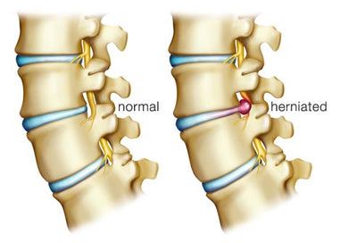 Spinal Nerve Compression: What Is It, and How Can It Be Treated?